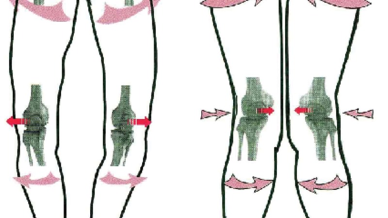 Wady kolan – koślawość i szpotawość | Centrum Fizjoterapii Rehabu